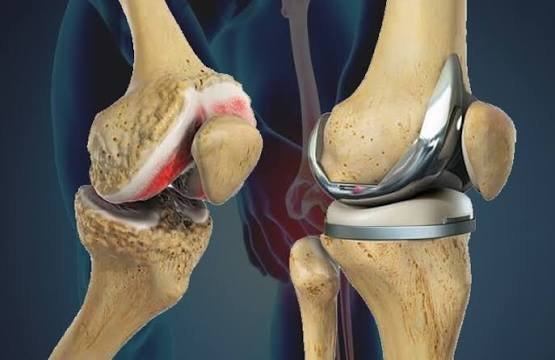 The Complete Guide to Knee Replacement Costs: India vs. USA